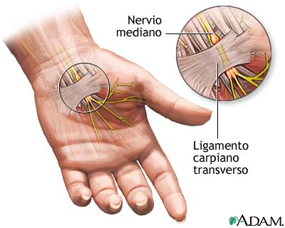 Sindrome del Tunel del Carpo