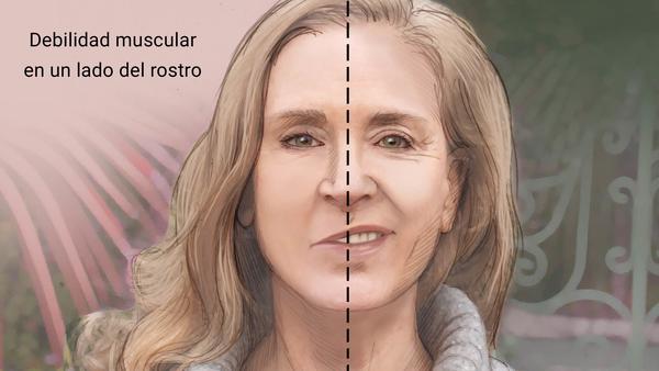 Paralisis Facial